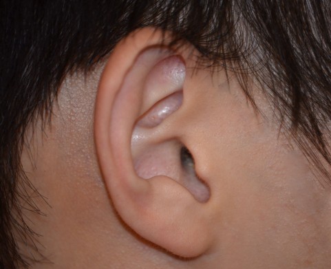 先天性耳瘻孔は耳の前方に現れるのが特徴がある