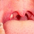 膿栓の取り方はうがいでのどの奥から唾液を出す